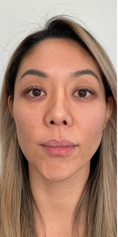 Lip Fillers Before & After Image