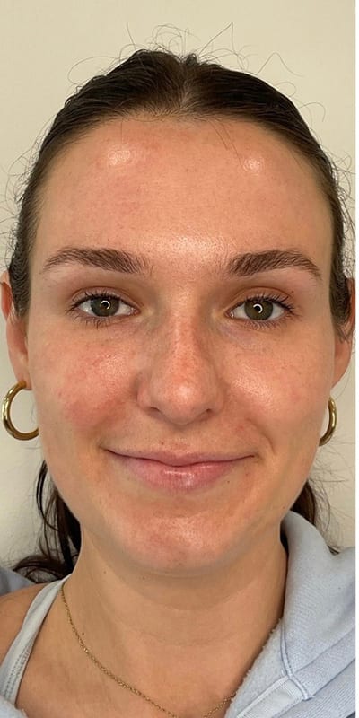 Lip Fillers Before & After Image