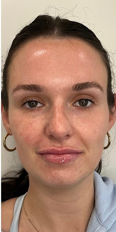 Lip Fillers Before & After Image