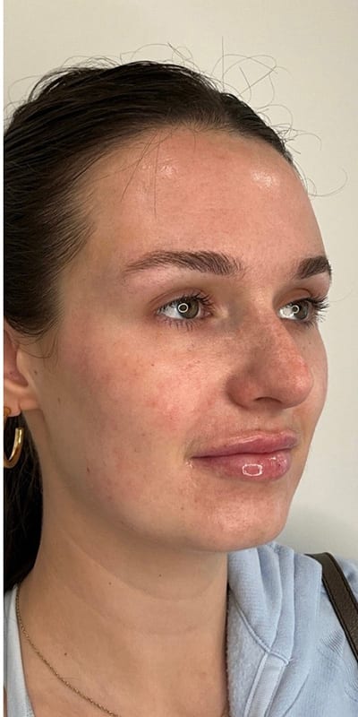 Lip Fillers Before & After Image