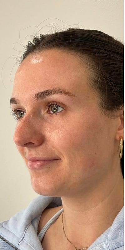 Lip Fillers Before & After Image
