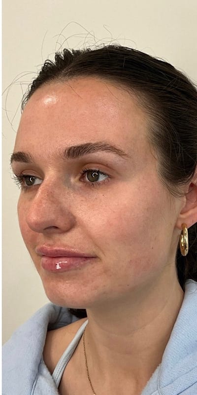 Lip Fillers Before & After Image