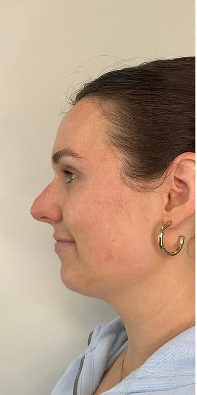 Lip Fillers Before & After Image