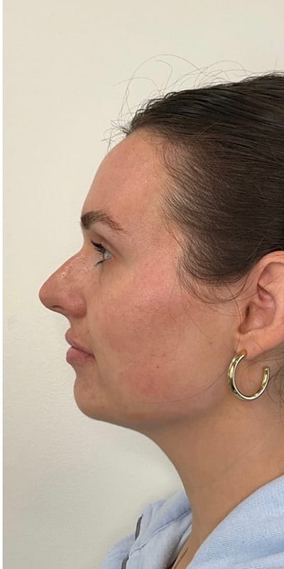 Lip Fillers Before & After Image