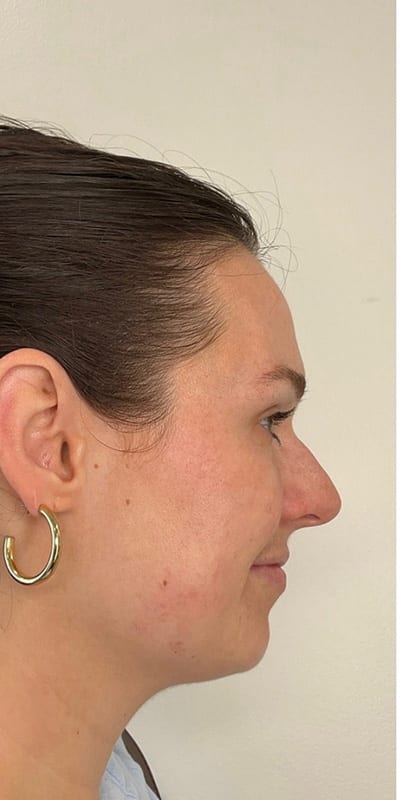 Lip Fillers Before & After Image