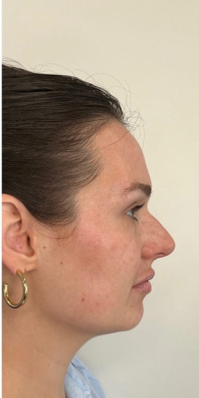 Lip Fillers Before & After Image