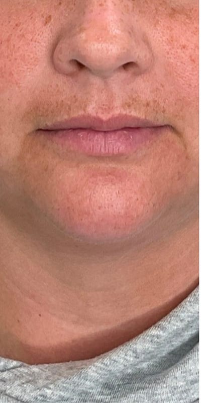 Lip Fillers Before & After Image