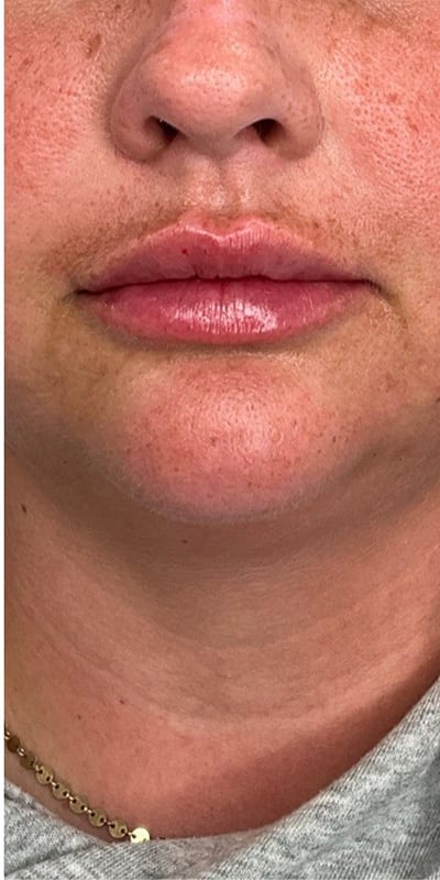 Lip Fillers Before & After Image
