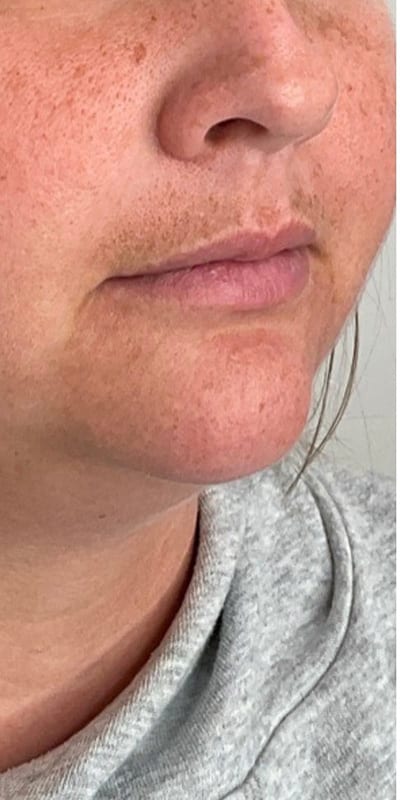 Lip Fillers Before & After Image