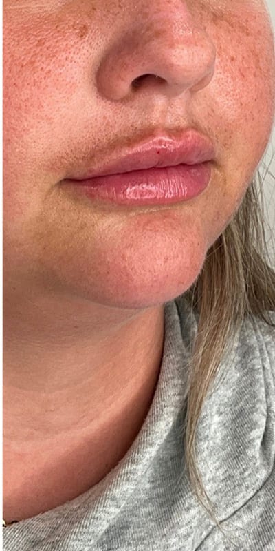 Lip Fillers Before & After Image