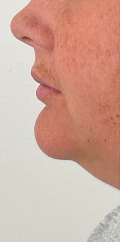 Lip Fillers Before & After Image
