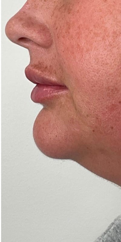 Lip Fillers Before & After Image