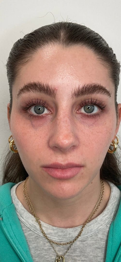 Lip Fillers Before & After Image
