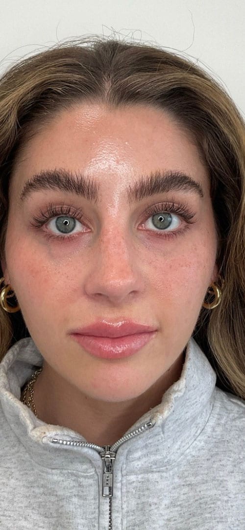 Lip Fillers Before & After Image