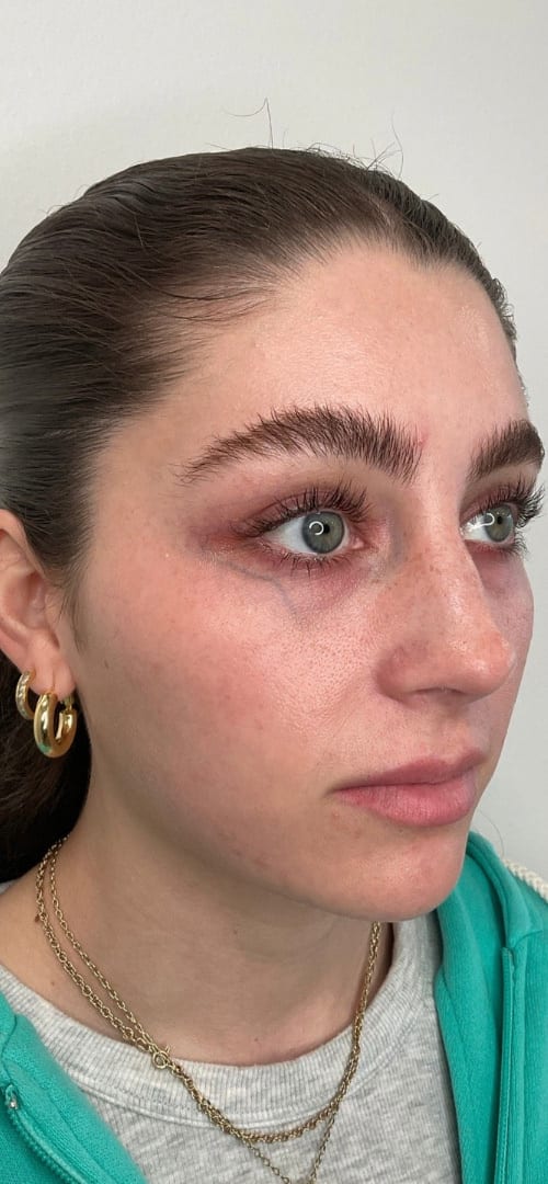 Lip Fillers Before & After Image