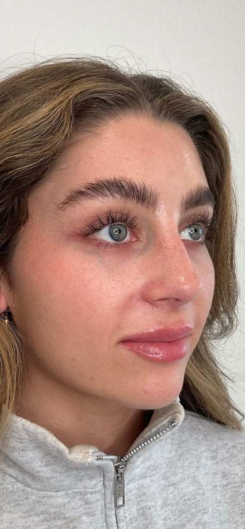Lip Fillers Before & After Image