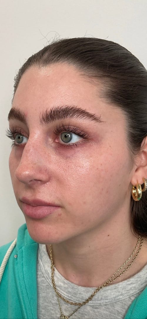 Lip Fillers Before & After Image