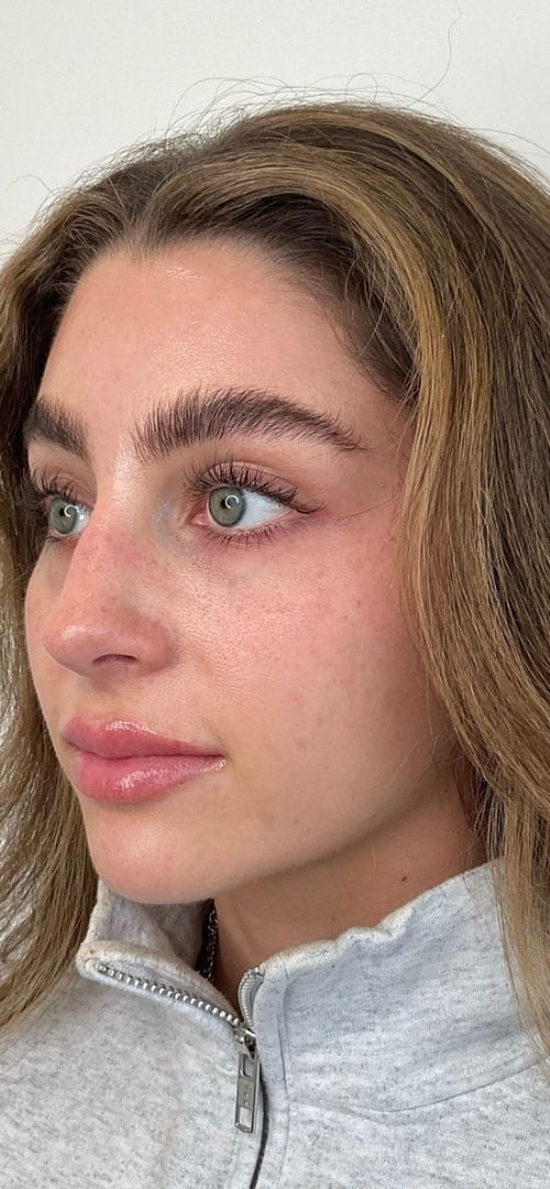 Lip Fillers Before & After Image