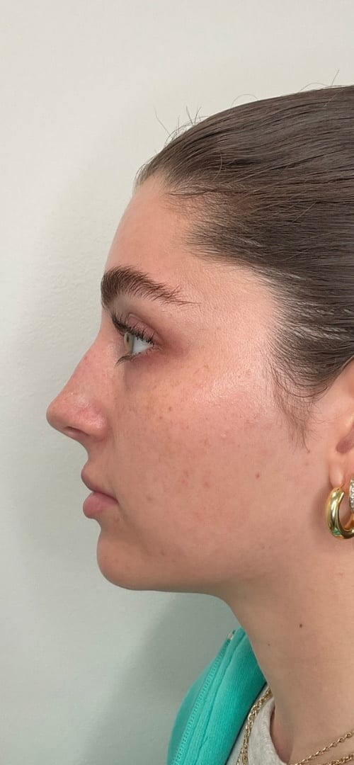 Lip Fillers Before & After Image