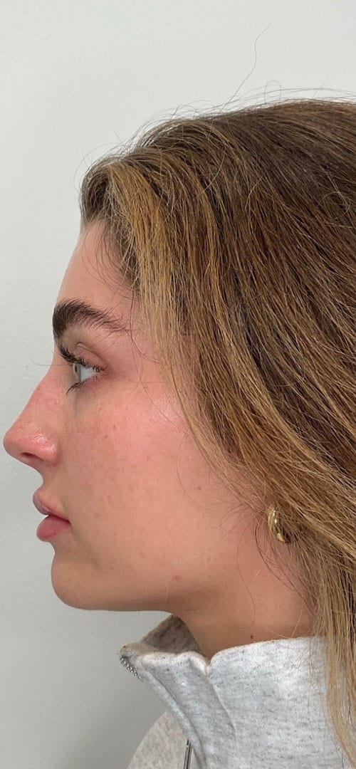 Lip Fillers Before & After Image