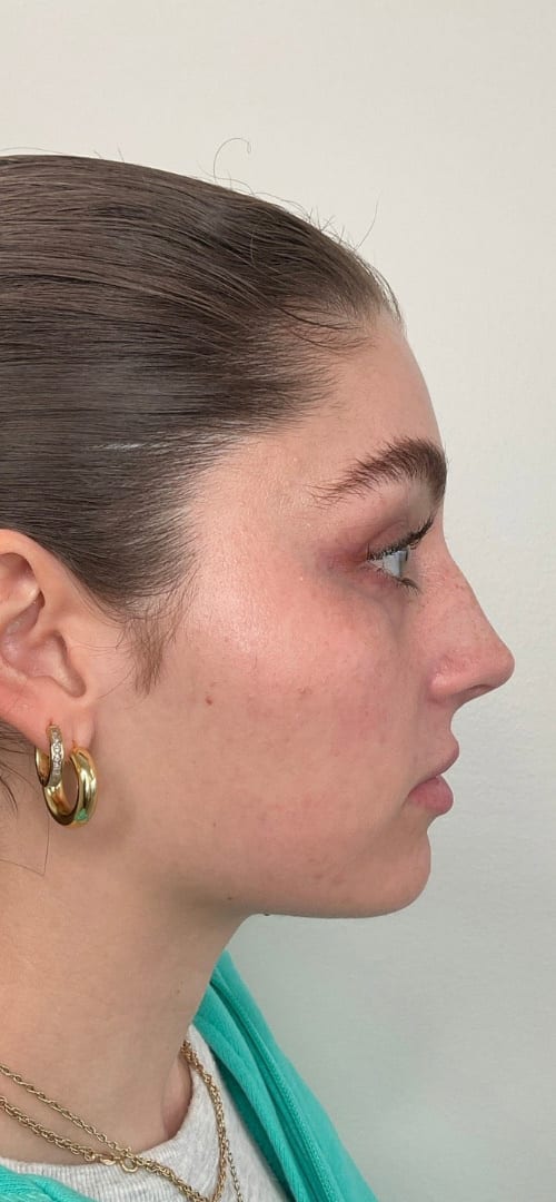 Lip Fillers Before & After Image