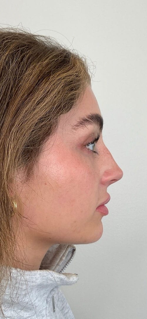 Lip Fillers Before & After Image