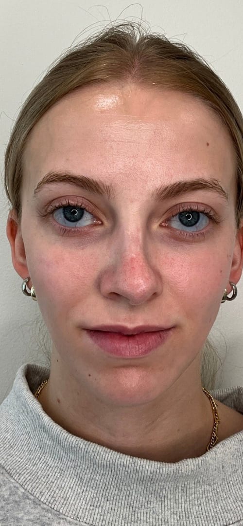 Lip Fillers Before & After Image