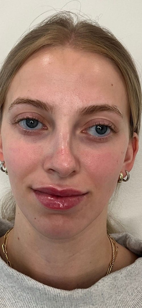 Lip Fillers Before & After Image