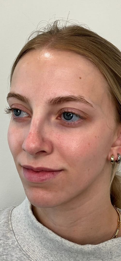 Lip Fillers Before & After Image
