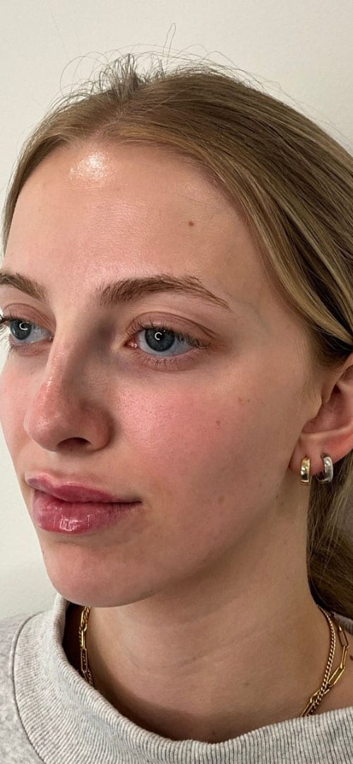 Lip Fillers Before & After Image