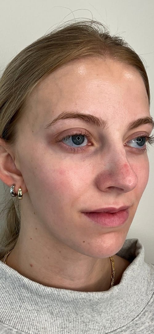 Lip Fillers Before & After Image
