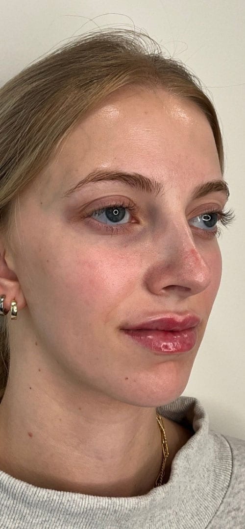 Lip Fillers Before & After Image