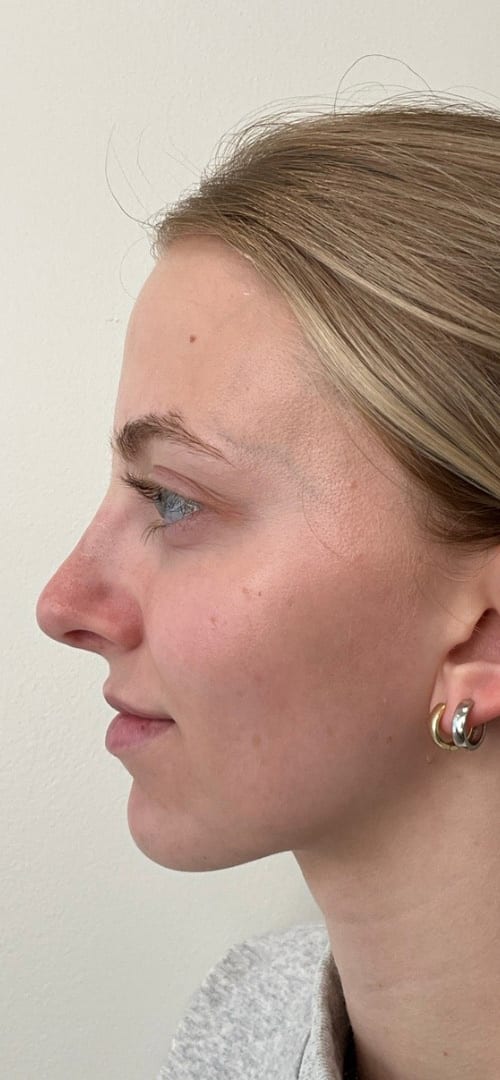 Lip Fillers Before & After Image