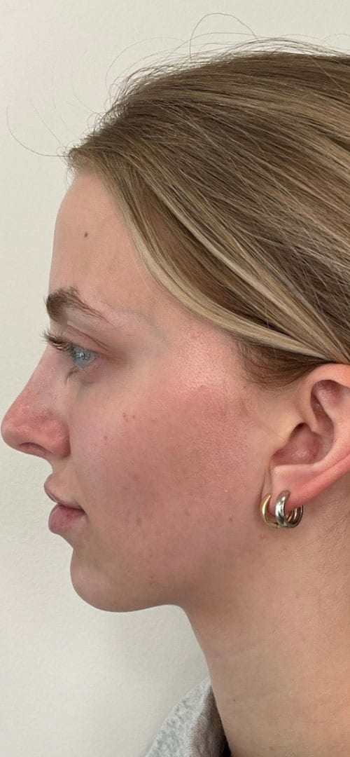 Lip Fillers Before & After Image