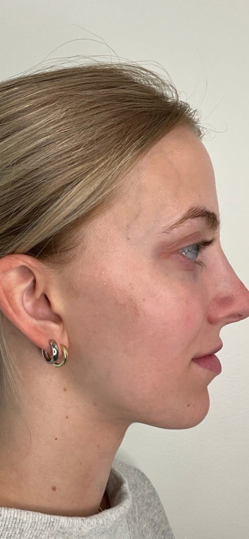 Lip Fillers Before & After Image