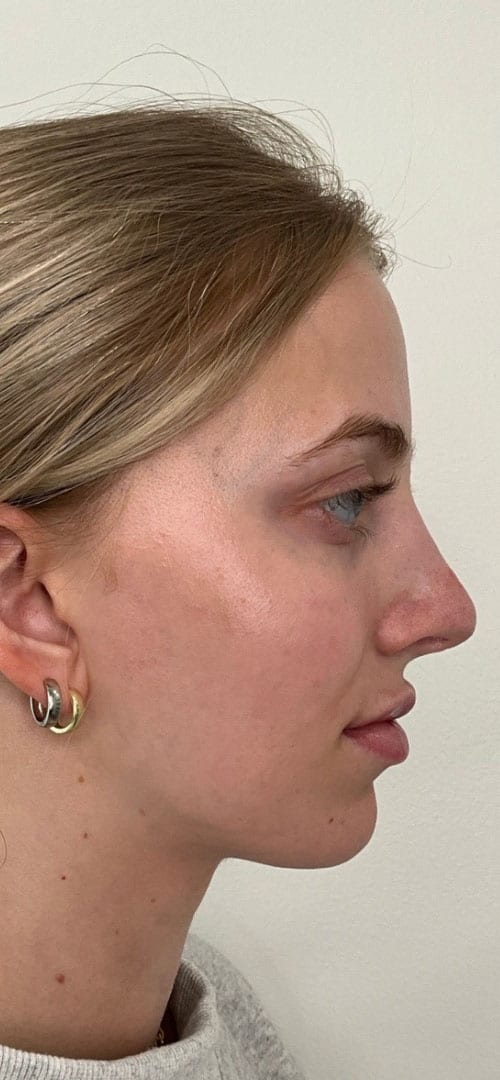 Lip Fillers Before & After Image