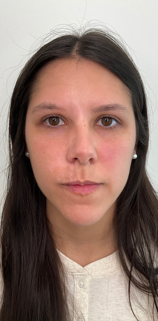 Lip Fillers Before & After Image