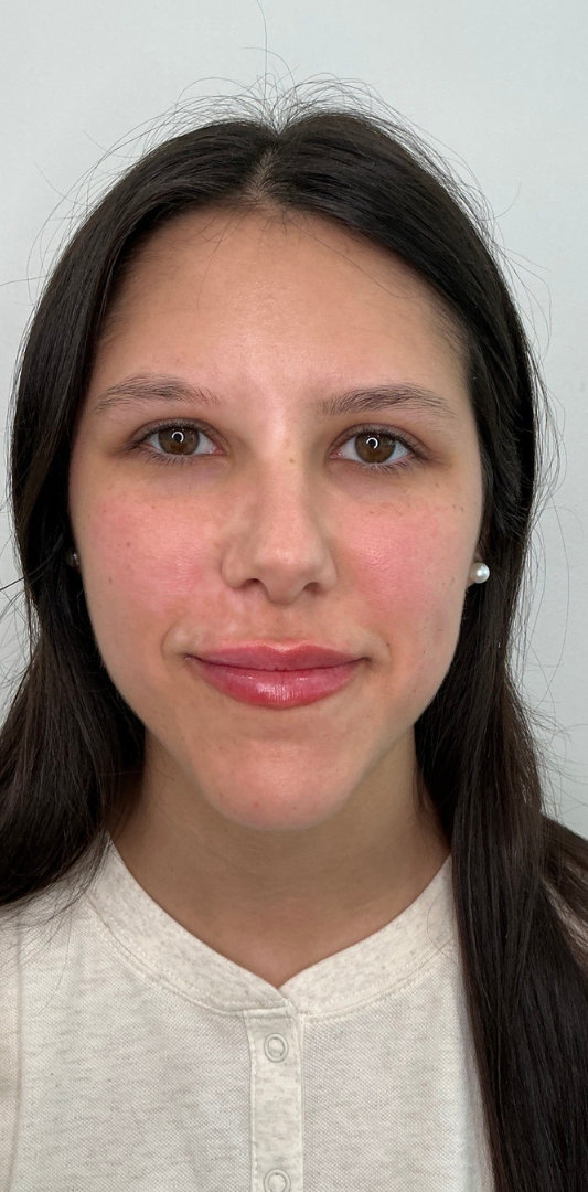 Lip Fillers Before & After Image