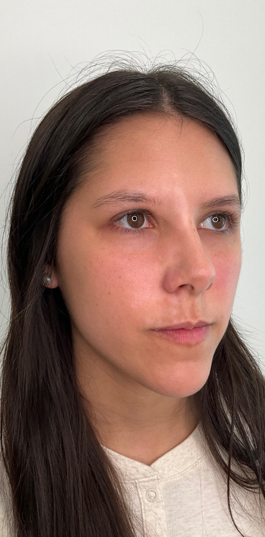 Lip Fillers Before & After Image