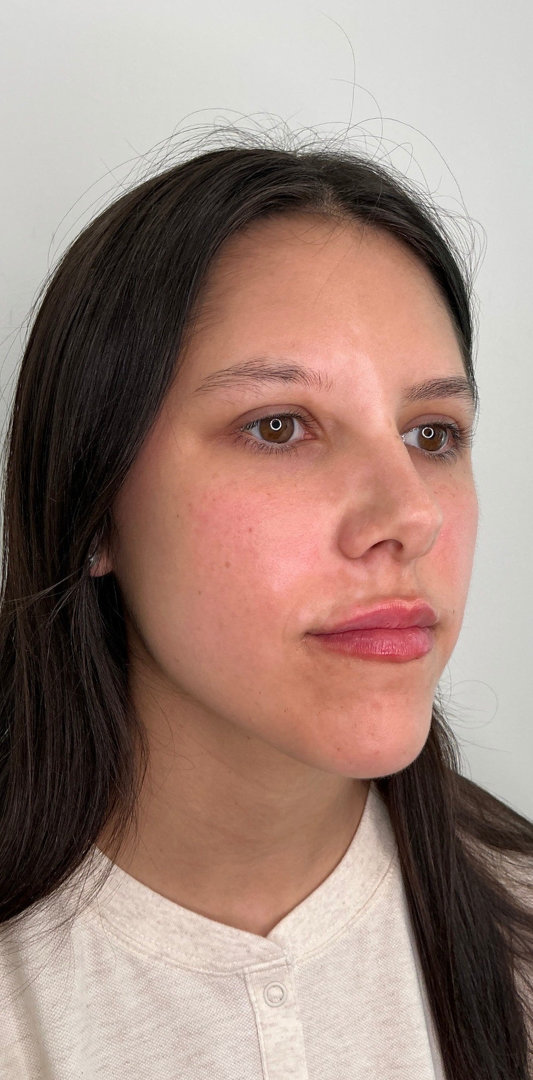 Lip Fillers Before & After Image