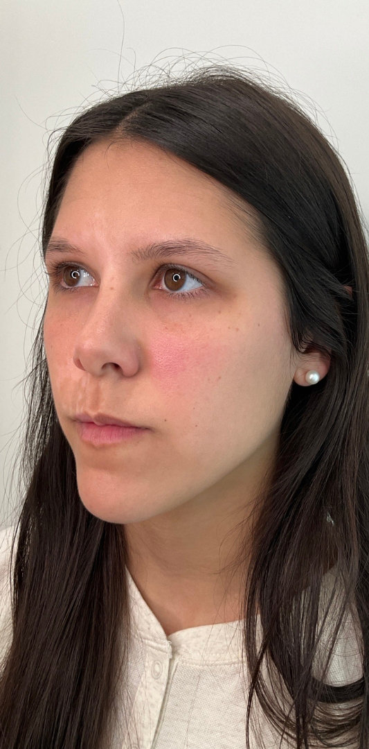 Lip Fillers Before & After Image