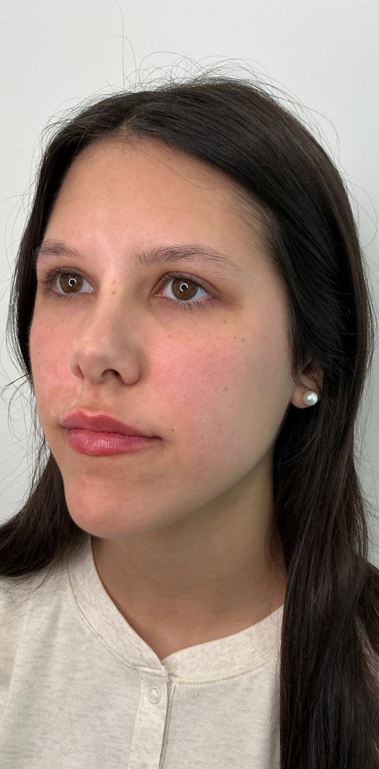 Lip Fillers Before & After Image