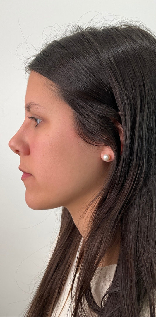Lip Fillers Before & After Image