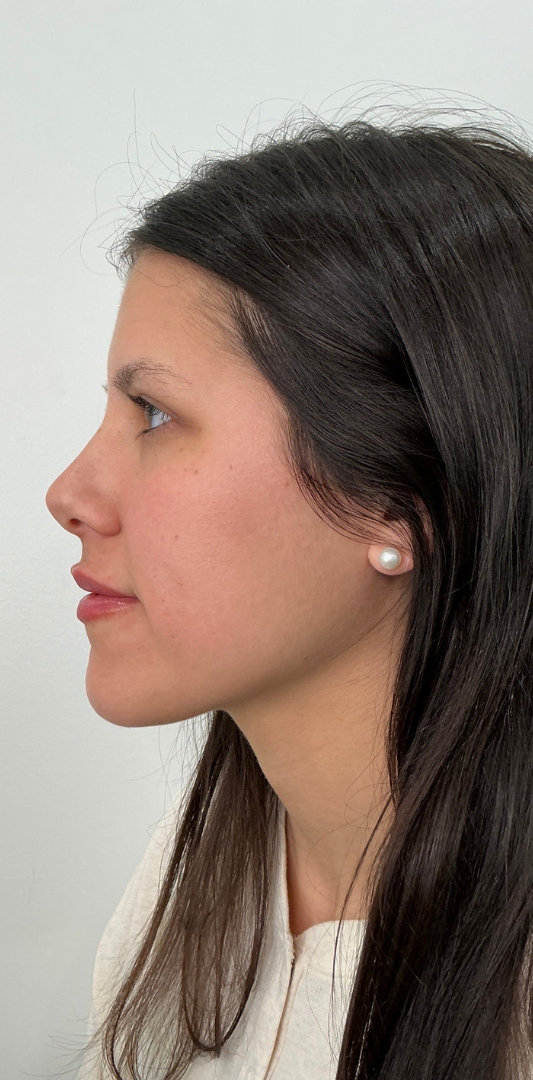 Lip Fillers Before & After Image
