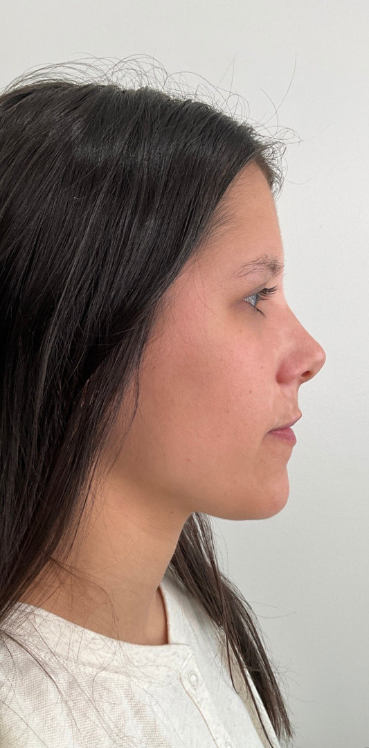 Lip Fillers Before & After Image