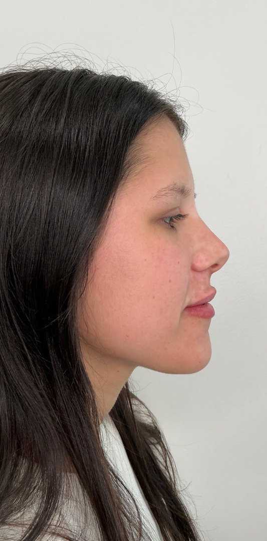 Lip Fillers Before & After Image