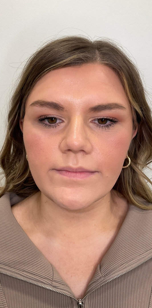 Lip Fillers Before & After Image