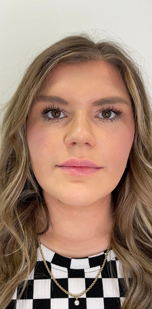 Lip Fillers Before & After Image