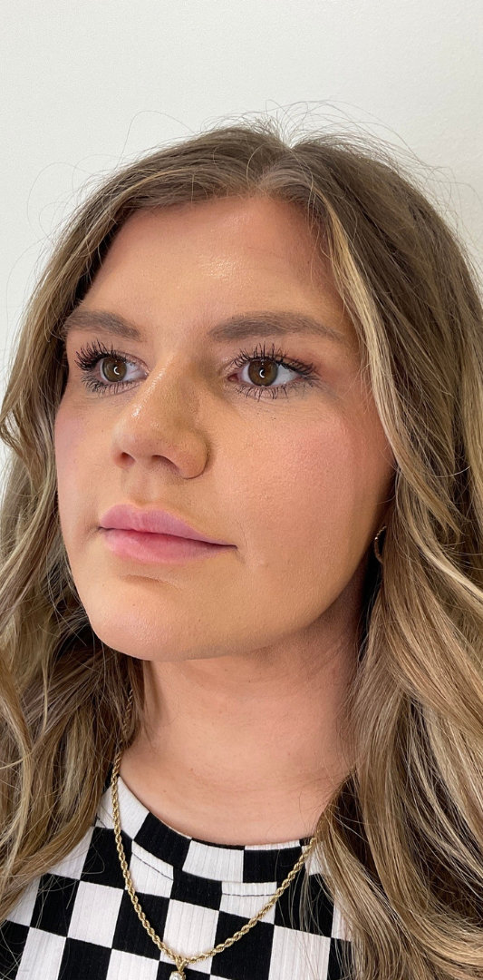 Lip Fillers Before & After Image