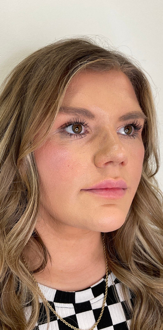 Lip Fillers Before & After Image